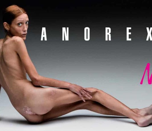 Anorexie, la maladie des ados