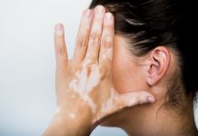 vitiligo maladie de peau dermatologie